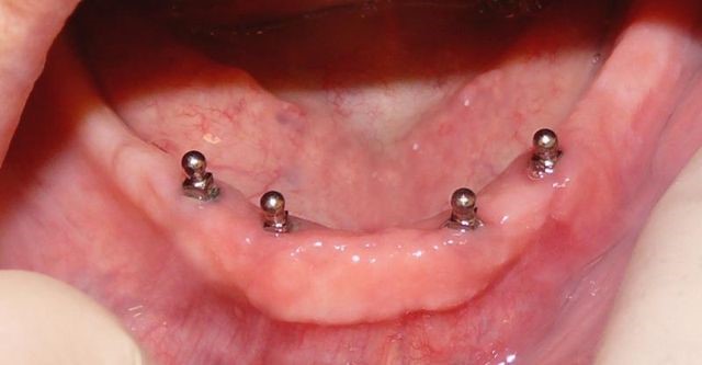 Partial 
      Dentures Before And After Metairie LA 70033